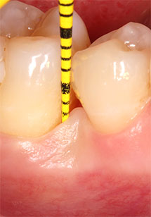 Щечная и язычная ГЗ ≤ 3 мм; BoP-мезиальный участок зуба 46