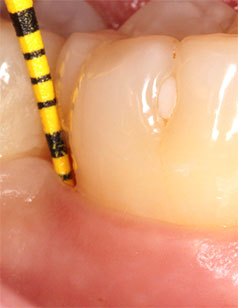 Щечная и язычная ГЗ ≤ 3 мм; BoP- дистальный участок зуба 46