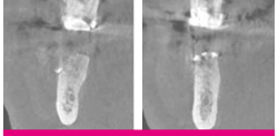 After 6 months. Cone beam computed tomography (CBCT) showing a significant amount of newly formed bone