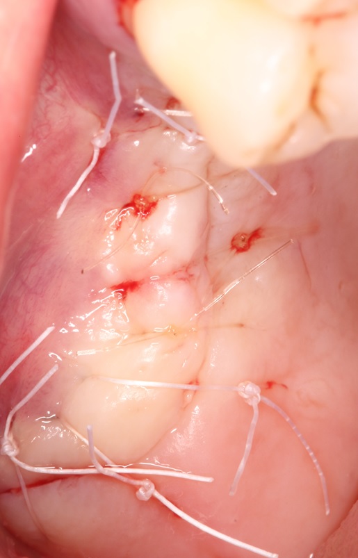 Coronally advanced flap (CAF) and suture