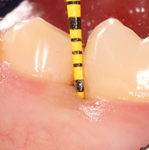 Щечная и язычная ГЗ ≤ 3 мм; BoP-мезиальный участок зуба 46