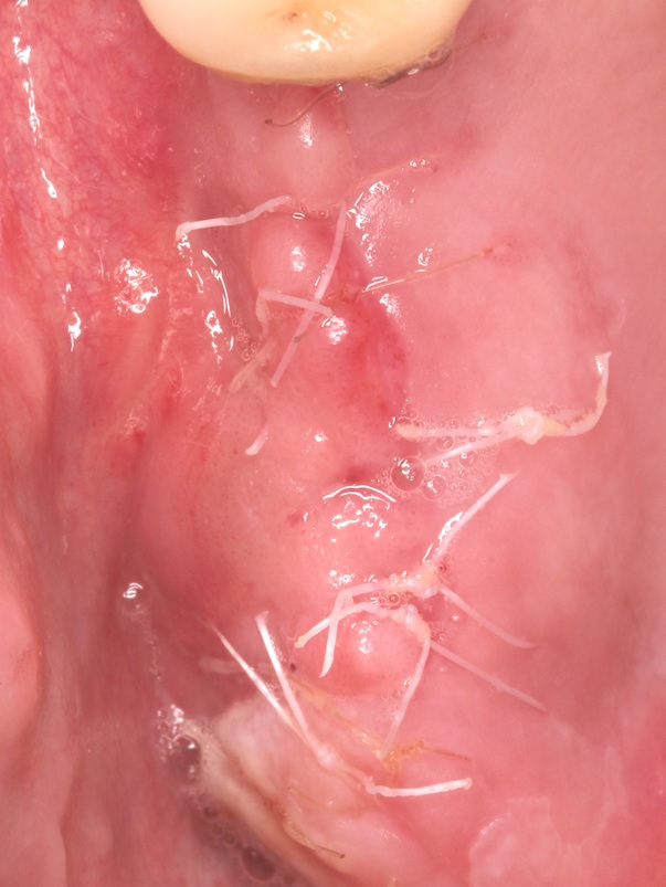 Coronally advanced flap (CAF) and suture