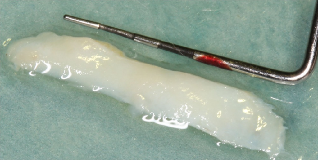 CTG retrieved from the palate using trap-door preparation
